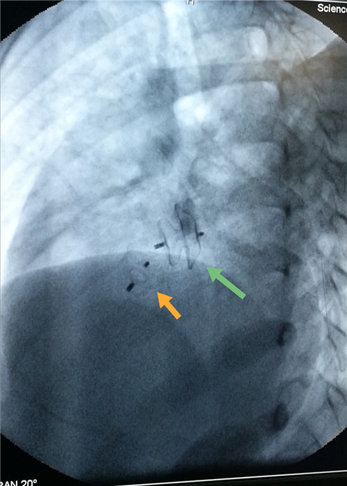 图7. 术后胸部X线左前斜位照可见2个封堵器，黄色箭头所指系主动脉窦瘤破裂封堵器，绿色箭头系房间隔缺损封堵器.jpg
