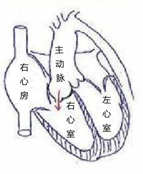 图2. 主动脉窦瘤破裂模式图，箭头所指方向为主动脉窦瘤破裂后血液经主动脉流入右心室.jpg