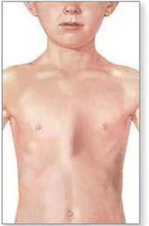 正中开胸手术切口易导致胸廓畸形.jpg